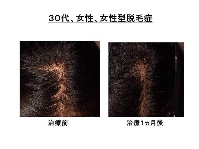 円形脱毛症　病院""